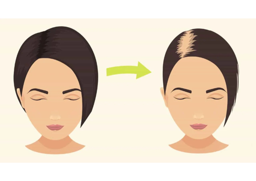 راه های جلوگیری از ریزش مو در نوجوانان, درمان سریع ریزش مو
