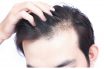 بهترین درمان ریزش موی شدید