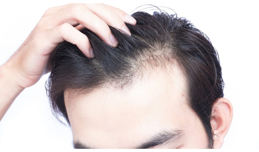 بهترین درمان ریزش موی شدید